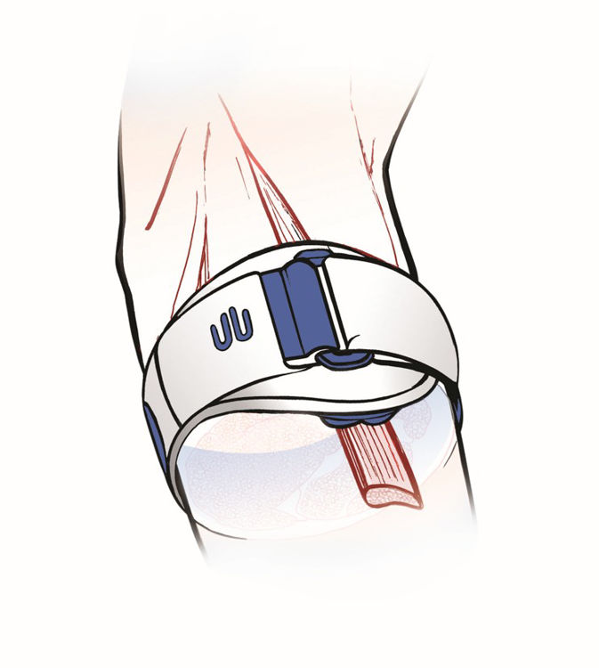 Mynd Bauerfeind EpiPoint